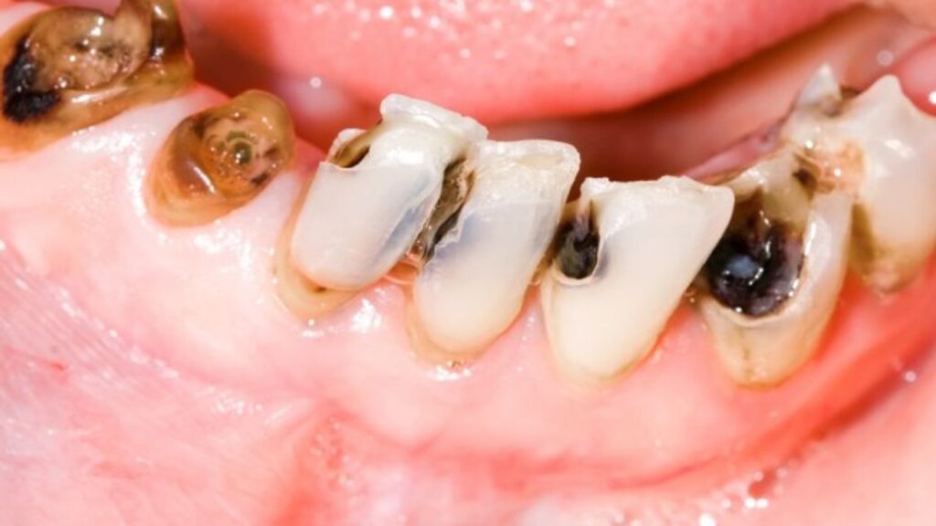 Sonhar com Larva no Dente Loteria