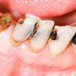 Sonhar com Larva no Dente Loteria