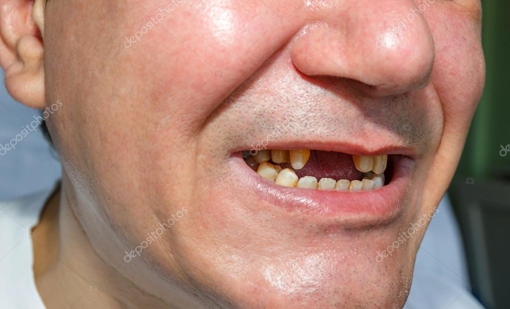 Sonhar com Pessoas sem Dente Bicho