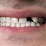 Sonhar com Pessoas sem Dente Loteria