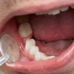 Sonhar com dente mole Bicho