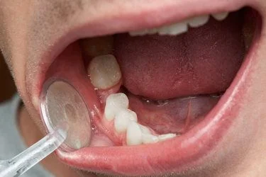 Sonhar com dente mole Bicho